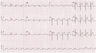 Case Report: ST-Segment Elevation in a Man With Acute Pericarditis